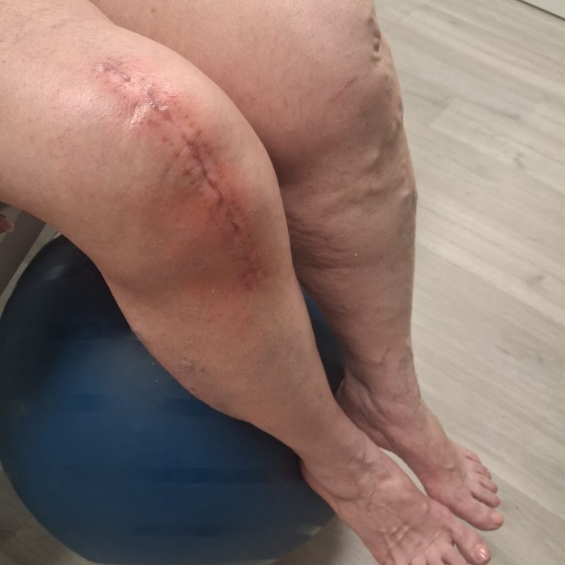 Rehabilitación de rodilla operada en Punto Fisio, Ciudad Lineal Rodilla con cicatriz de cirugía apoyada sobre un balón durante un ejercicio de rehabilitación en Punto Fisio, Ciudad Lineal